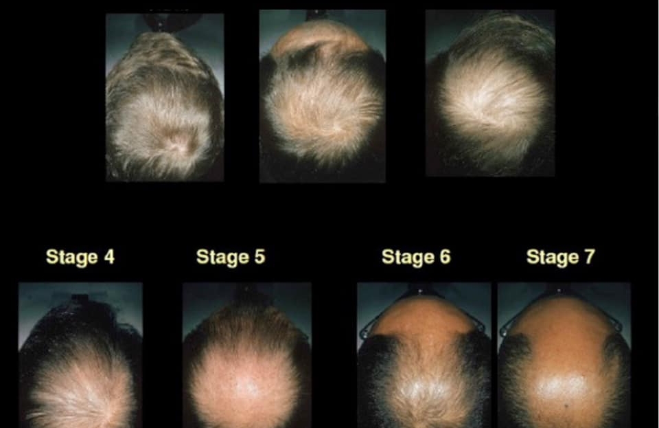 Platelet Rich Plasma (PRP), an effective treatment for hair loss