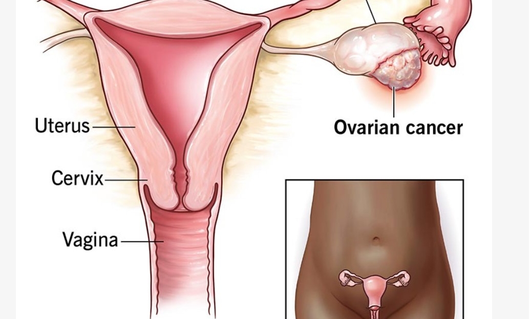 PARP Inhibitors in Ovarian cancer