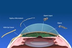 Understanding MIGS: A new frontier in Glaucoma surgery