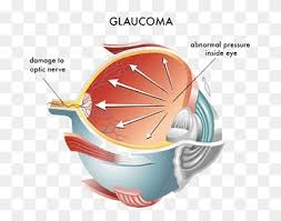 Understanding Glaucoma: Types, Causes, Risk Factors, and Symptoms