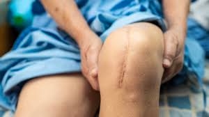 Navigating partial knee replacement