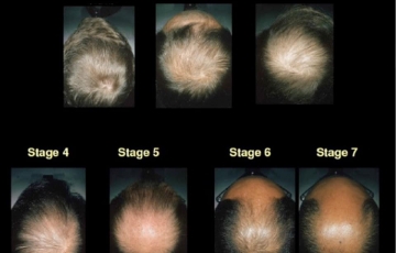 Platelet Rich Plasma (PRP), an effective treatment for hair loss