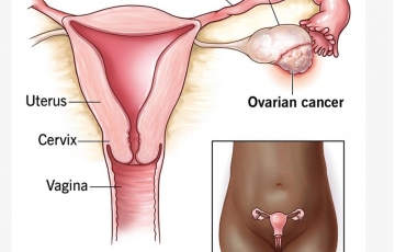 PARP Inhibitors in Ovarian cancer